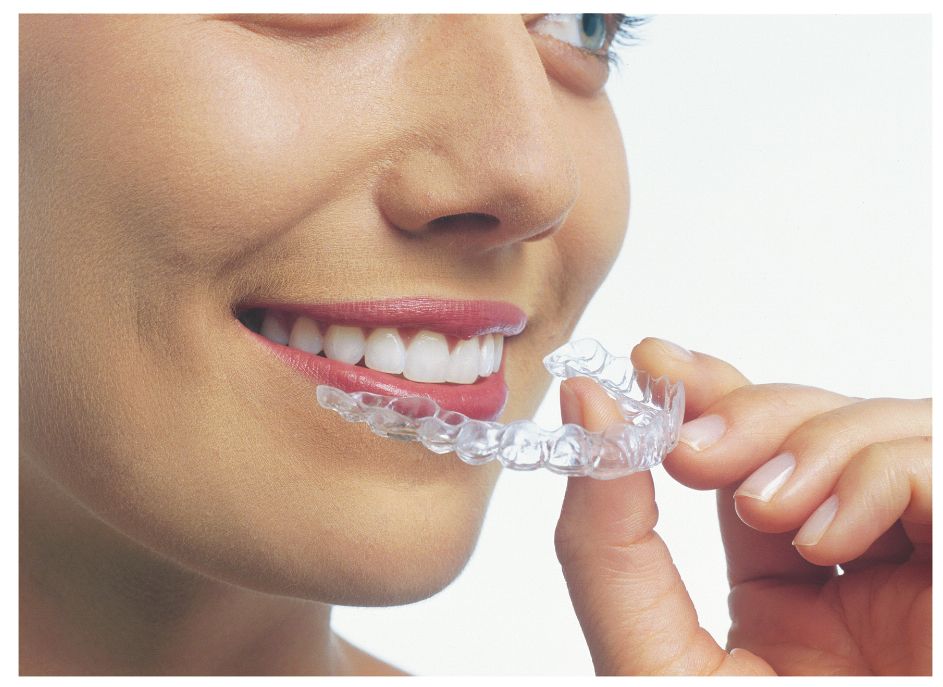 Invisalign clear braces